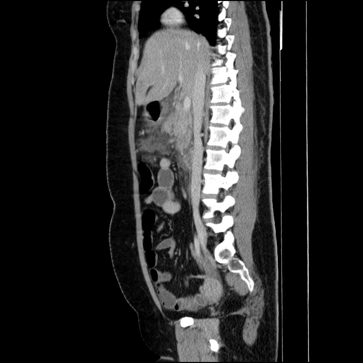 Acute pancreatitis (Radiopaedia 69236-79012 Sagittal C+ portal venous phase 59).jpg