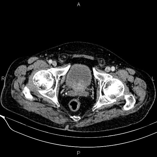 Acute pancreatitis (Radiopaedia 85146-100701 Axial C+ portal venous phase 61).jpg