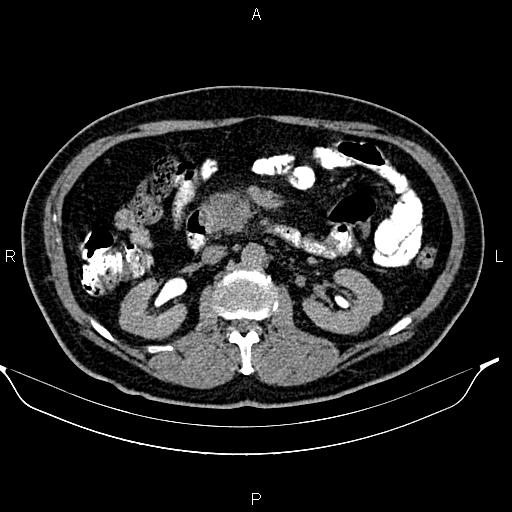 Acute pancreatitis (Radiopaedia 85390-101010 Axial C+ delayed 35).jpg