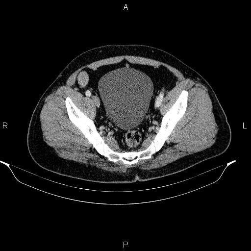 Acute pancreatitis (Radiopaedia 85390-101010 Axial C+ portal venous phase 92).jpg