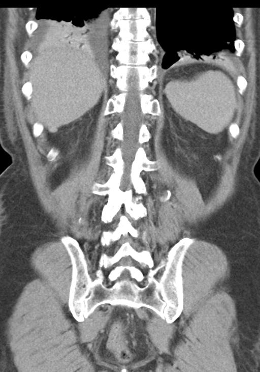 Acute pancreatitis and walled-off necrosis (Radiopaedia 29888-30403 E 45).jpg