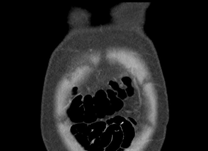 Acute pancreatitis and walled-off necrosis (Radiopaedia 29888-30404 Coronal C+ portal venous phase 6).jpg