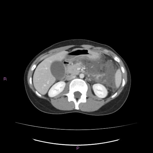 Acute pancreatitis secondary to stone at minor papilla and pancreatic divisum (Radiopaedia 76570-88333 Axial C+ portal venous phase 31).jpg