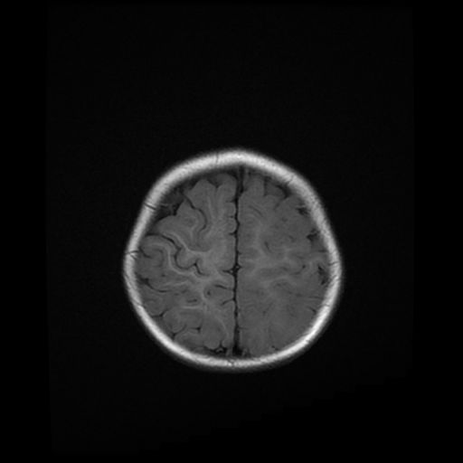File:Acute phase of hemiconvulsion-hemiplegia epilepsy syndrome (Radiopaedia 29309-29745 Axial T1 5).jpg