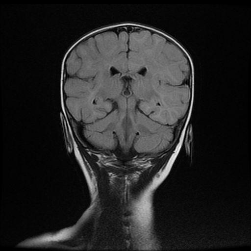 File:Acute phase of hemiconvulsion-hemiplegia epilepsy syndrome (Radiopaedia 29309-29745 Coronal FLAIR 14).jpg