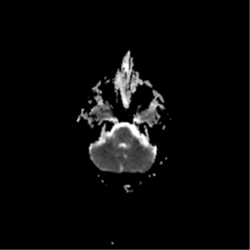 File:Acute pontine infarct from vertebral artery dissection (Radiopaedia 34111-35370 Axial ADC 5).png
