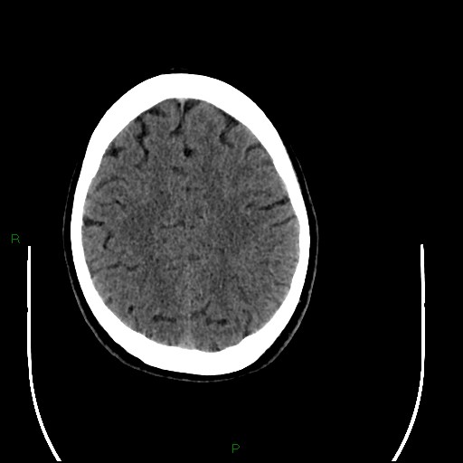Acute posterior cerebral artery territory infarct (Radiopaedia 79329-92393 Axial non-contrast 82).jpg
