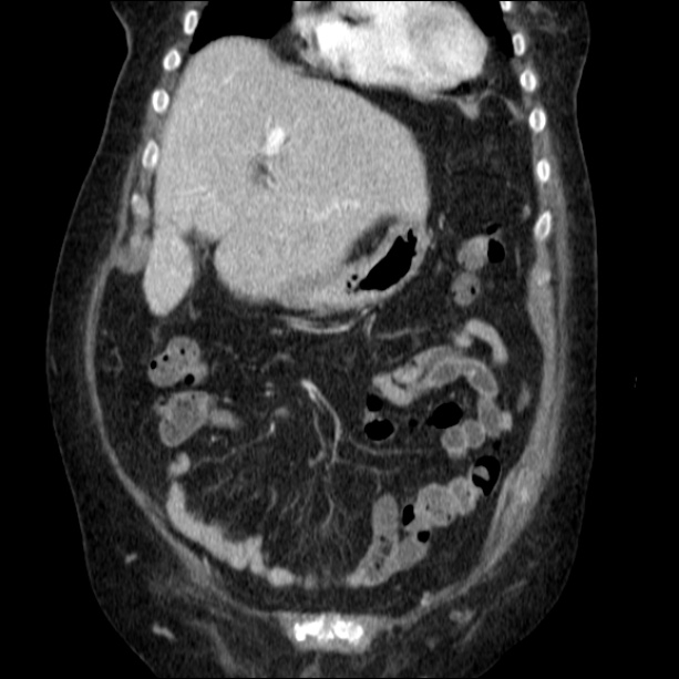 Acute pyelonephritis (Radiopaedia 26584-26729 C+ portal venous phase 23).jpg
