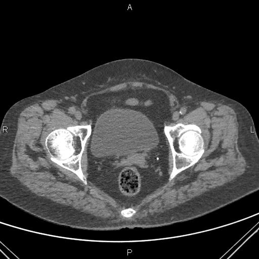 Acute renal artery occlusion (Radiopaedia 86586-102682 Axial non-contrast 87).jpg