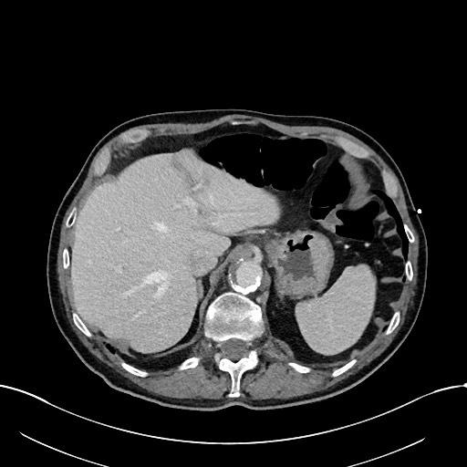 File:Acute renal infarction (Radiopaedia 59375-66736 Axial C+ portal venous phase 18).jpg