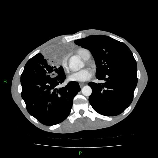 File:Acute right lung abscess (Radiopaedia 34806-36258 Axial C+ arterial phase 112).jpg
