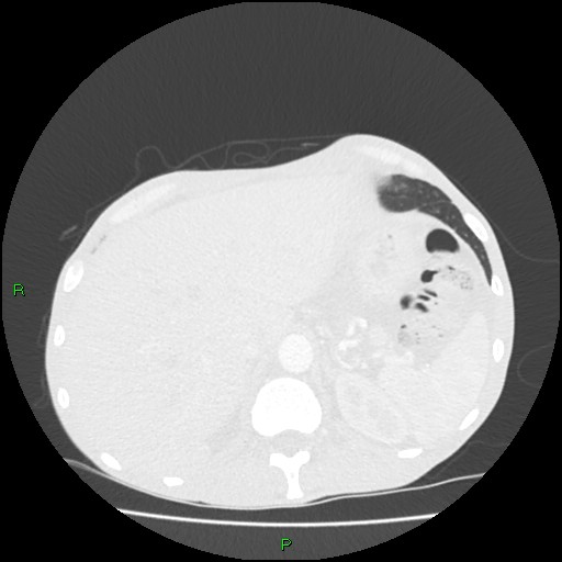 Acute right lung abscess (Radiopaedia 34806-36258 Axial lung window 179).jpg