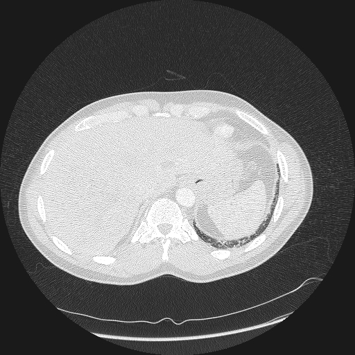 Acute segmental pulmonary emboli and pulmonary infarction (Radiopaedia 62264-70444 Axial lung window 177).jpg