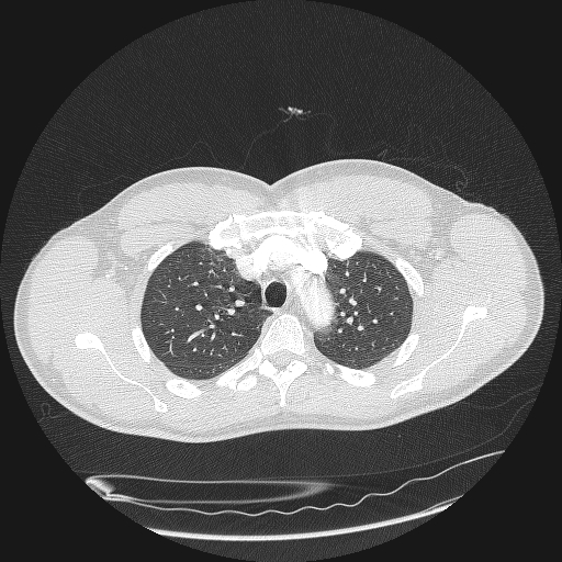 Acute segmental pulmonary emboli and pulmonary infarction (Radiopaedia 62264-70444 Axial lung window 41).jpg