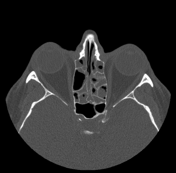 Acute sinusitis (Radiopaedia 23161-23215 Axial bone window 45).jpg