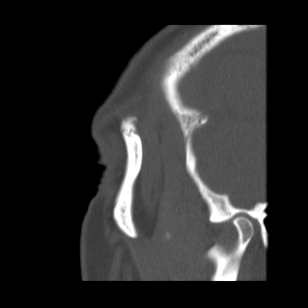 Acute sinusitis (Radiopaedia 23161-23215 Sagittal bone window 58).jpg