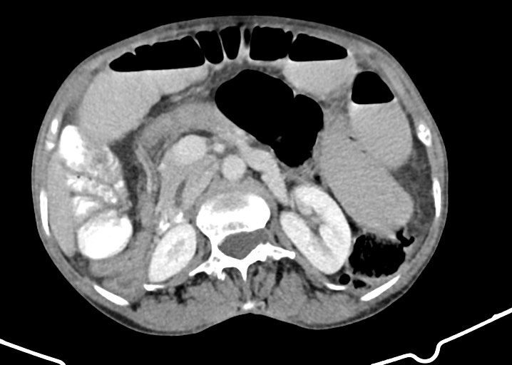 Acute small bowel (ileal) volvulus (Radiopaedia 71740-82139 Axial C+ portal venous phase 86).jpg