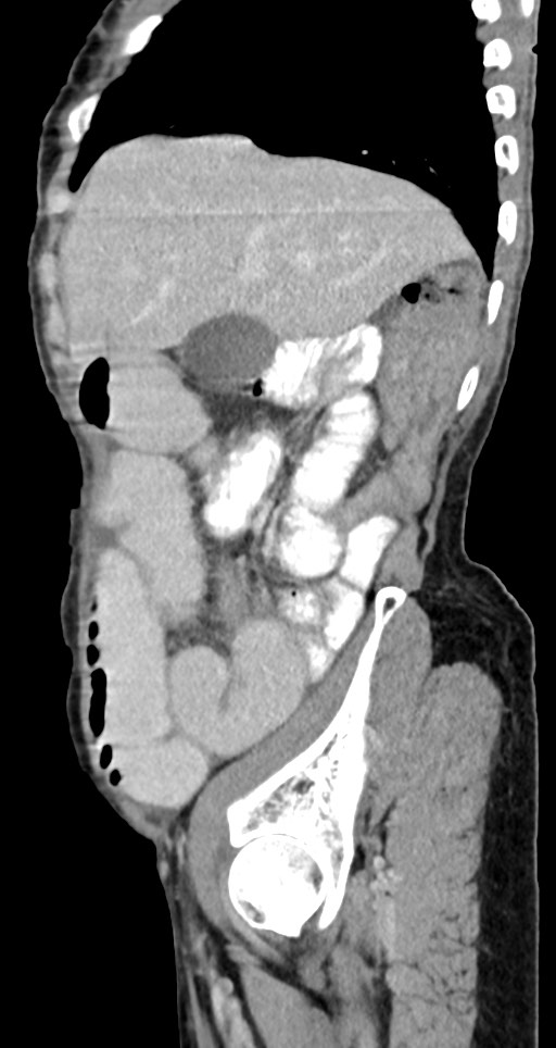 Acute small bowel (ileal) volvulus (Radiopaedia 71740-82139 Sagittal C+ portal venous phase 124).jpg
