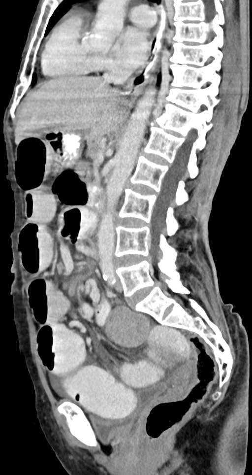 Acute small bowel (ileal) volvulus (Radiopaedia 71740-82139 Sagittal C+ portal venous phase 89).jpg