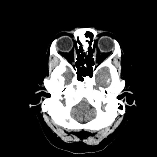 Acute subarachnoid hemorrhage and accessory anterior cerebral artery (Radiopaedia 69231-79008 Axial non-contrast 9).jpg
