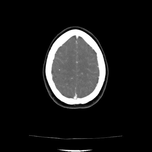 Acute subarachnoid hemorrhage and accessory anterior cerebral artery (Radiopaedia 69231-79009 Axial C+ arterial phase 116).jpg