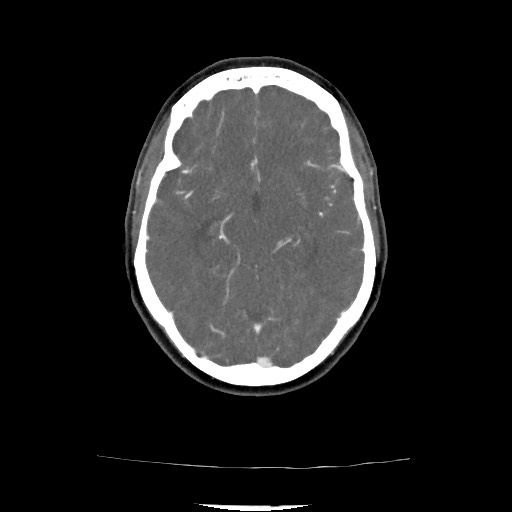 Acute subarachnoid hemorrhage and accessory anterior cerebral artery (Radiopaedia 69231-79009 Axial C+ arterial phase 94).jpg