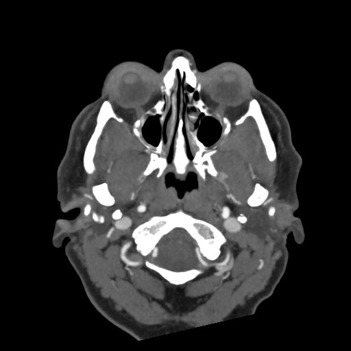 Acute subarachnoid hemorrhage and accessory anterior cerebral artery (Radiopaedia 69231-79009 D 8).jpg