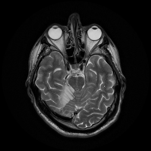 File:Acute superior cerebellar artery territory infarct (Radiopaedia 84104-99358 Axial T2 22).jpg