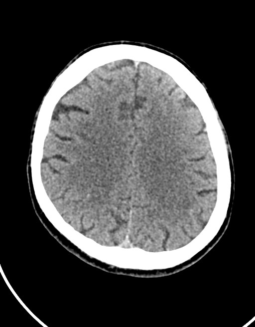 Acute superior cerebellar artery territory infarct (Radiopaedia 84104-99359 Axial non-contrast 25).jpg