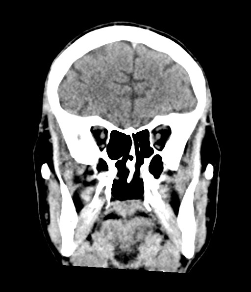 Acute superior cerebellar artery territory infarct (Radiopaedia 84104-99359 Coronal non-contrast 34).jpg