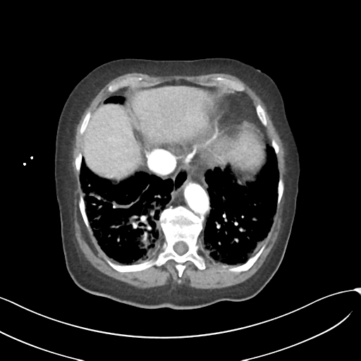 File:Acute superior mesenteric artery occlusion (Radiopaedia 43926-47418 Axial C+ portal venous phase 9).png
