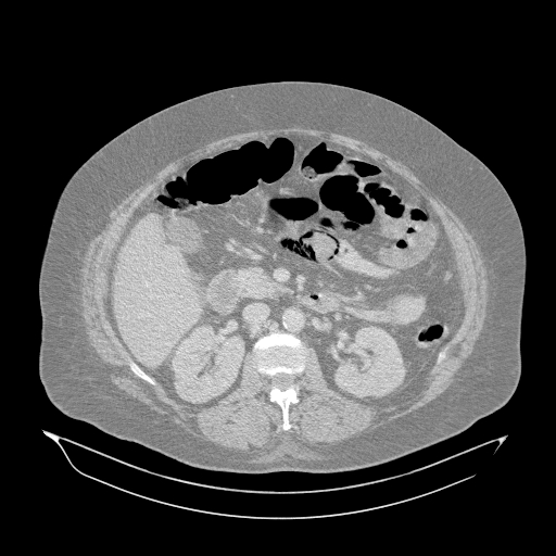 Acute superior mesenteric artery occlusion (Radiopaedia 51288-56960 Axial lung window 20).jpg