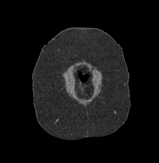 Acute superior mesenteric artery occlusion (Radiopaedia 51288-56960 Coronal C+ portal venous phase 1).jpg