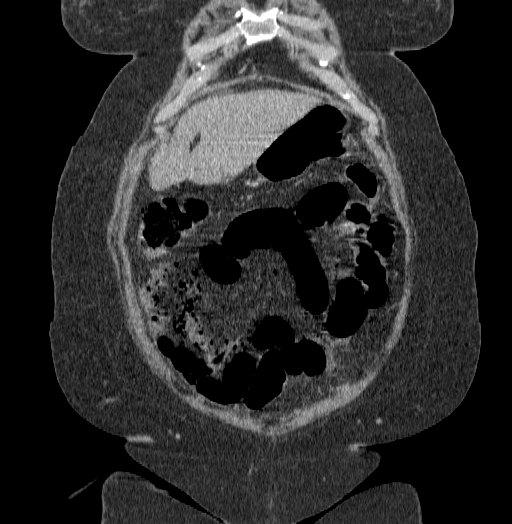 File:Acute superior mesenteric artery occlusion (Radiopaedia 51288-56960 Coronal C+ portal venous phase 17).jpg