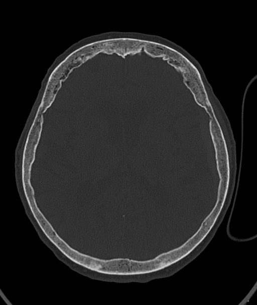 Acute traumatic subdural hematoma (Radiopaedia 82921-97257 Axial bone window 52).jpg