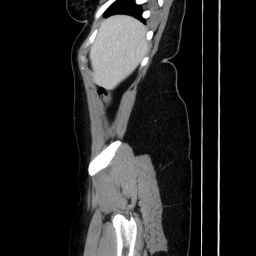 Acute uncomplicated appendicitis (Radiopaedia 73704-84499 Sagittal C+ portal venous phase 55).jpg