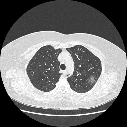 Adenocarcinoma in situ of lung (Radiopaedia 38685-40829 B 62).png