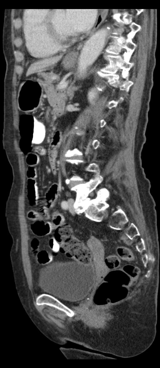 Adenocarcinoma of cecum (Radiopaedia 59222-66549 Sagittal C+ portal venous phase 36).jpg