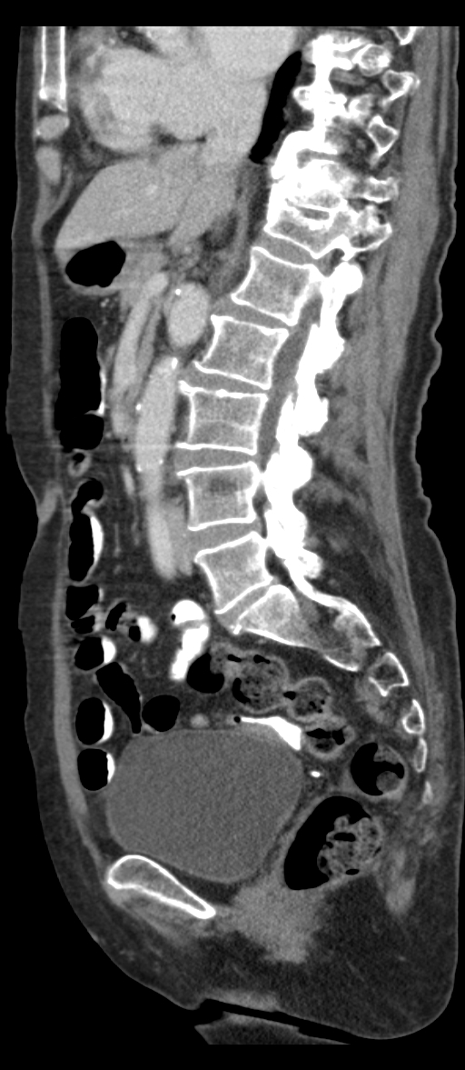 Adenocarcinoma of cecum (Radiopaedia 59222-66549 Sagittal C+ portal venous phase 50).jpg