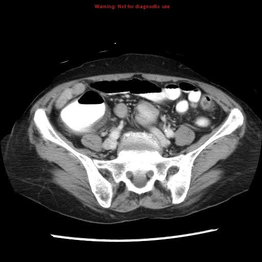 Adenocarcinoma of the colon (Radiopaedia 8191-9039 Axial liver window 53).jpg