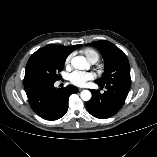 Adenocarcinoma of the lung (Radiopaedia 59871-67325 Axial C+ arterial phase 51).jpg