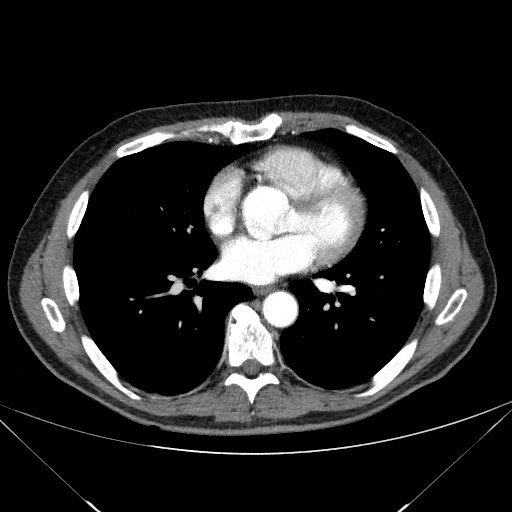 File:Adenocarcinoma of the lung (Radiopaedia 59871-67325 Axial C+ arterial phase 55).jpg