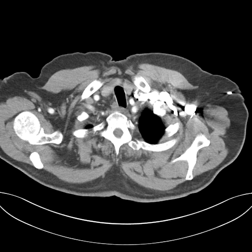 Adenocarcioma of rectum- T1 lesion (Radiopaedia 36921-38547 Axial C+ arterial phase 8).png