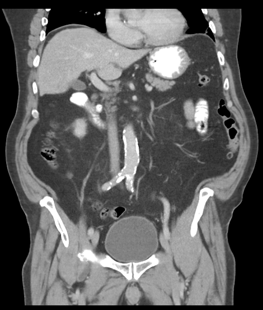 Adenocarcioma of rectum- T1 lesion (Radiopaedia 36921-38547 Coronal C+ portal venous phase 30).png