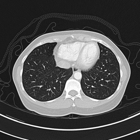 Adenocystic carcinoma of the trachea (Radiopaedia 47677-52525 Axial lung window 68).jpg