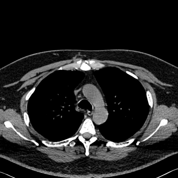 File:Adenoid cystic carcinoma of the trachea (Radiopaedia 49042-54137 Axial non-contrast 104).jpg