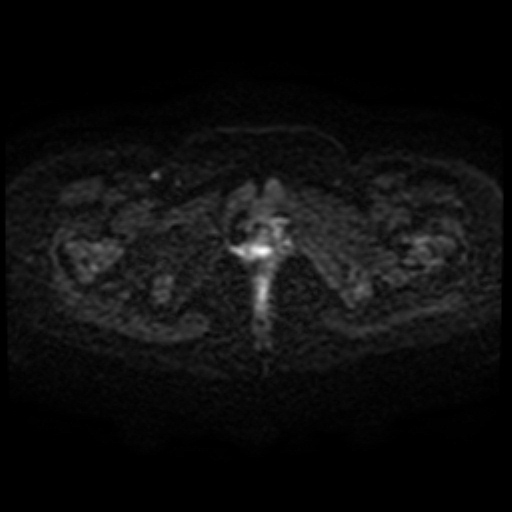 File:Adenoma malignum of cervix (Radiopaedia 66441-75705 Axial DWI 72).jpg