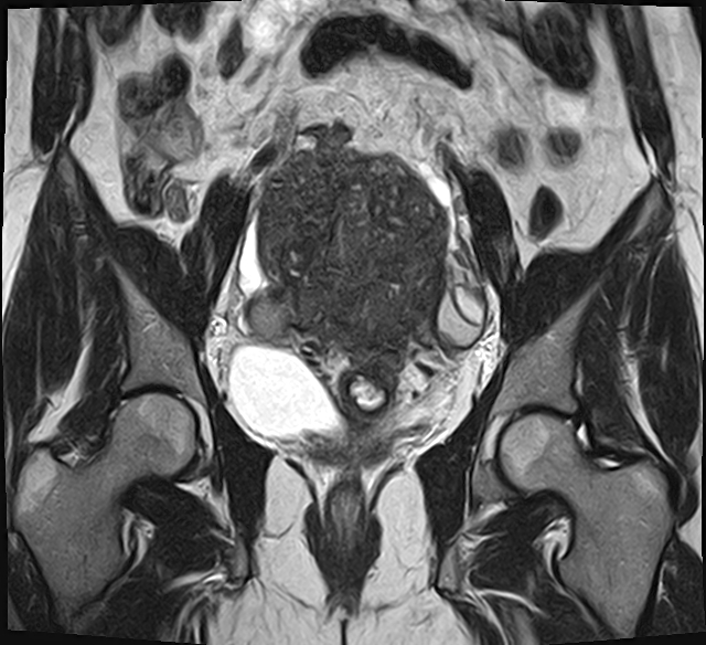 File:Adenomyosis - ovarian endometriomas (Radiopaedia 67031-76350 Coronal T2 15).jpg