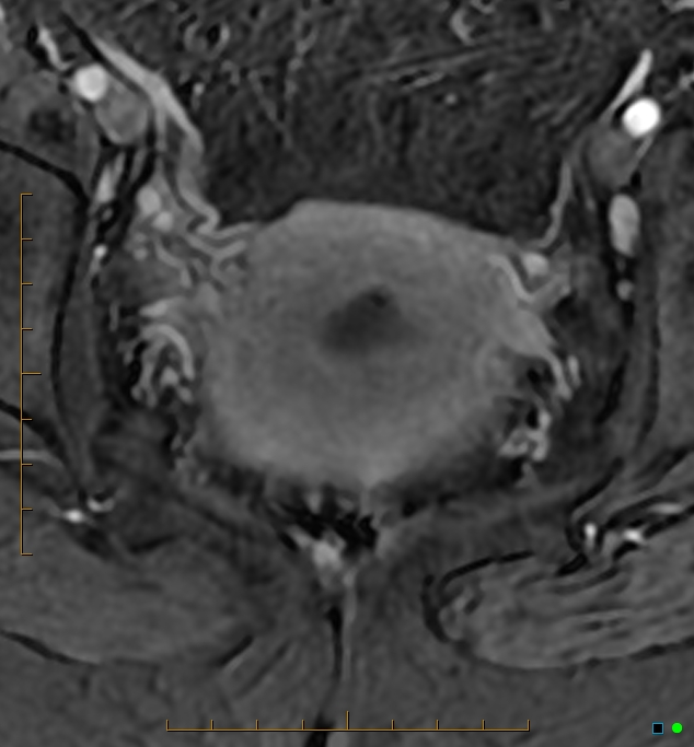 Adenomyosis uterus with hematometra (Radiopaedia 45779-50011 Axial T1 C+ fat sat 43).jpg