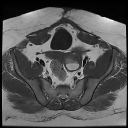 File:Adenomyosis within a didelphys uterus (Radiopaedia 70175-80215 Axial T1 21).jpg
